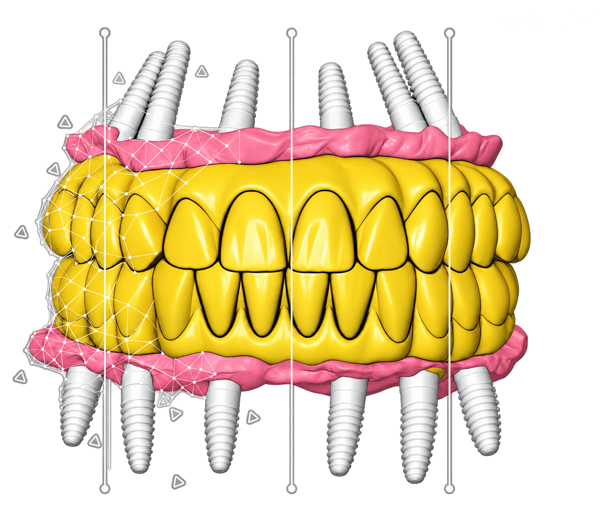 exocad DentalCAD